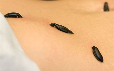 Leech Therapy treatment